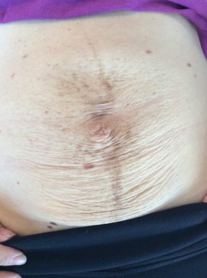 Diastasis skin changes